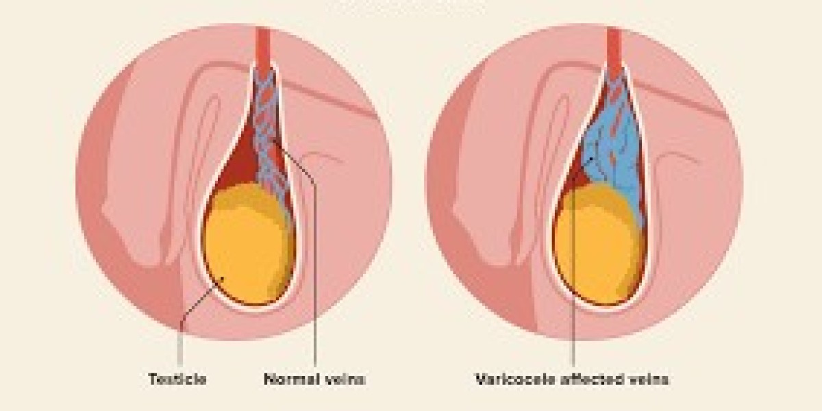 Does Hitting the Gym Cause Varicocele? Here’s the Truth