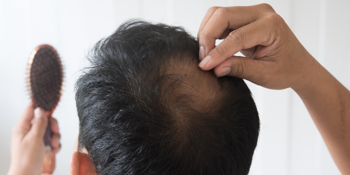 Affordable 3000 Grafts & Hairline Transplant at QHT Clinic – Natural Results, Expert Care