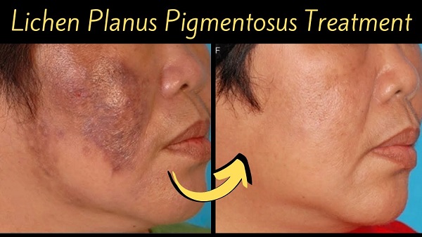 Living with Lichen Pl**** Pigmentosus: Expert Tips for Skin Care - Herbal Care Products - Blog